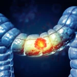 A Simple At-Home Test Could Cut Colorectal Cancer Death Risk by 43%
