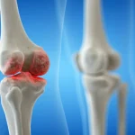 Knee Osteoarthritis Isn’t Inevitable: What You Can Do