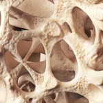 Osteopenia: The Silent Bone-Loss Condition Affecting Millions Worldwide